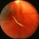 Ophthalmomyasis